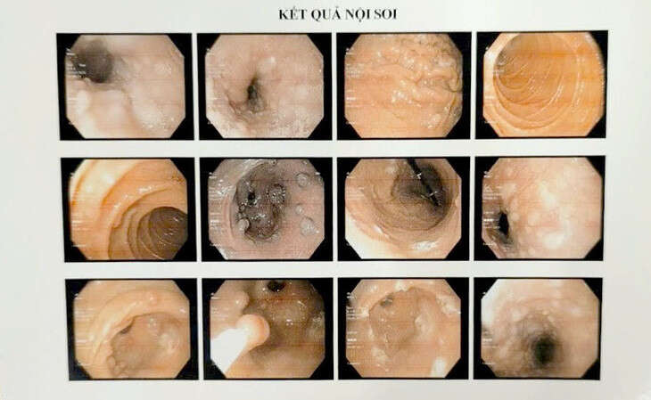 Hy hữu ca bệnh có u chi chít trong dạ dày và mọc khắp cơ thể