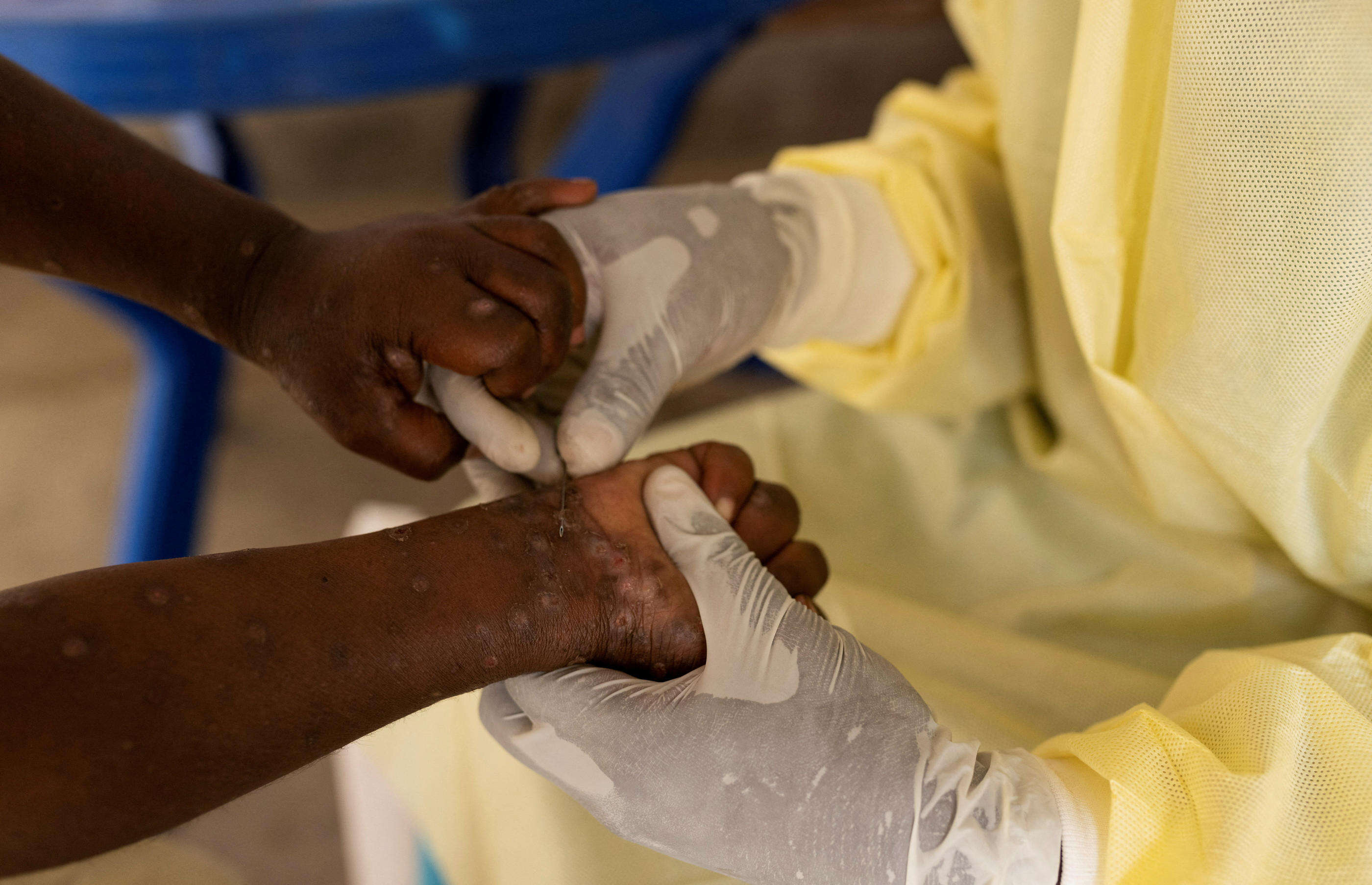 Mpox : 866 morts de l’épidémie depuis le début de l’année sur le continent africain