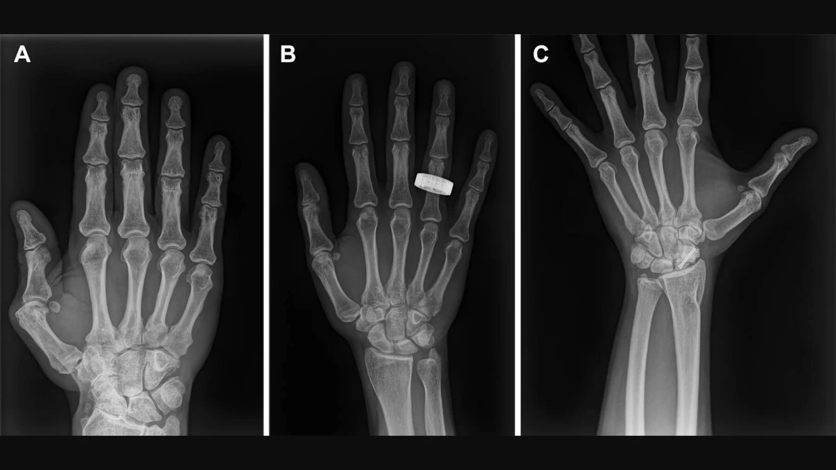 Astronauts take first X-rays in space