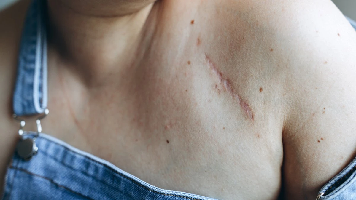 Why scars never disappear
