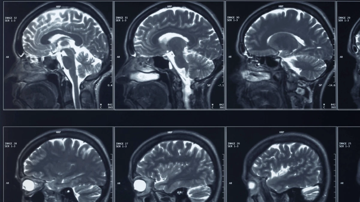 A brain implant to treat depression gets FDA greenlight to start trials