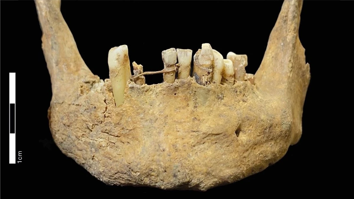 A medieval Scot rocked a 20-carat gold dental bridge
