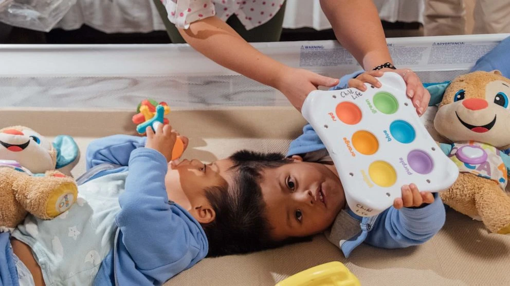 Doctors who separated conjoined twins speak out