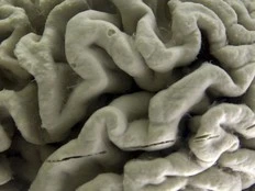European regulators OK Alzheimer’s treatment Leqembi after initial doubts