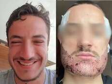 French man dies by suicide after failed beard transplant by 'estate agent': 'He entered a vicious cycle'