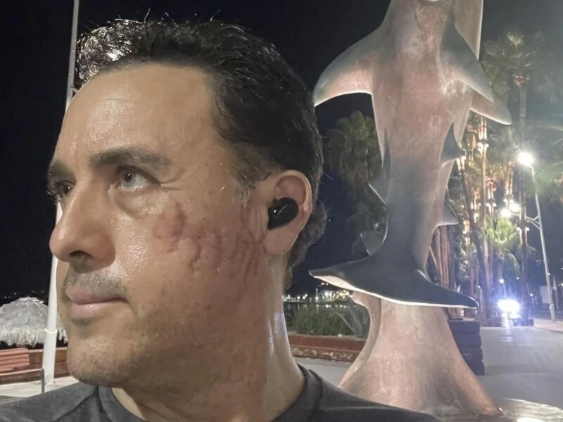 Мексиканський біолог сподівається знову зустріти акулу, яка вкусила його за голову