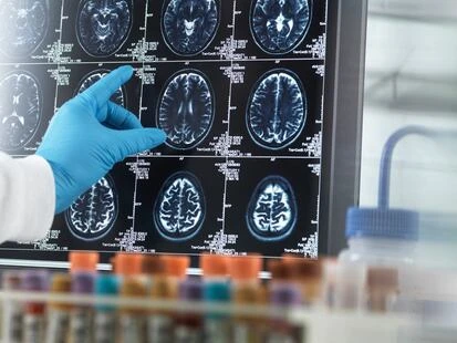 AVC, Alzheimer… L’inquiétante progression des pathologies neurologiques