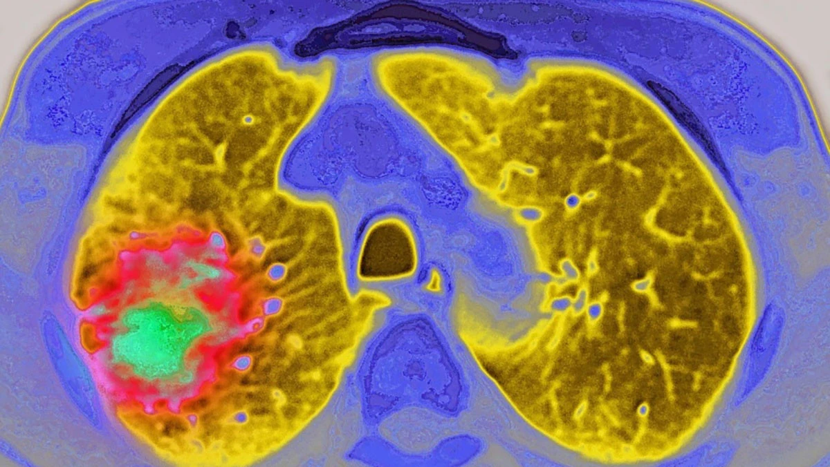 A blood test has been added to colorectal cancer screening options. Here's what to know.