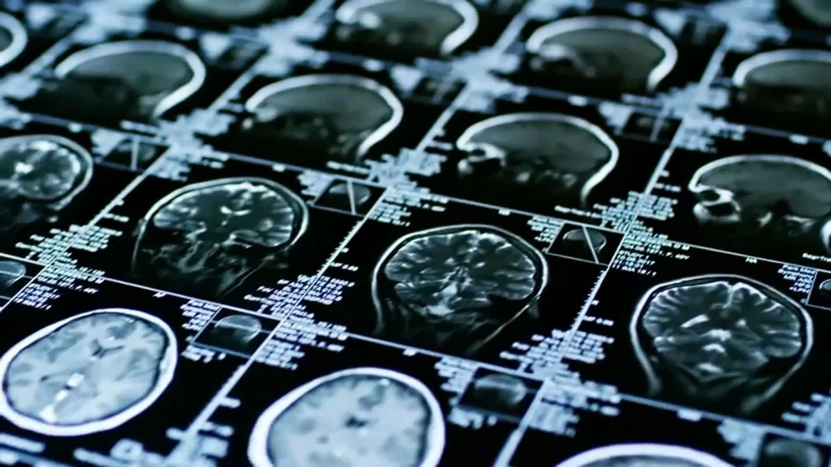 Study examines if 4 lifestyle changes can prevent or reverse Alzheimer's