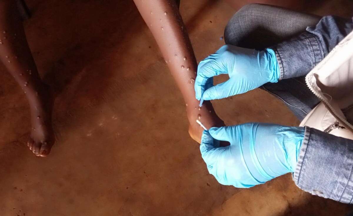 Mpox Cases Confirmed in More African Countries