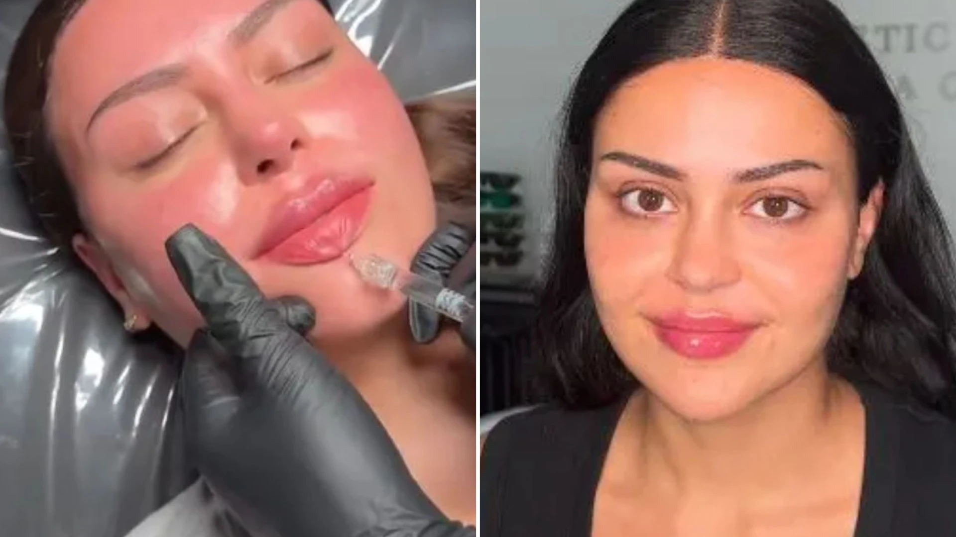 Love Island star Emma’s pre-villa glow up as she gets lip, chin & cheek fillers