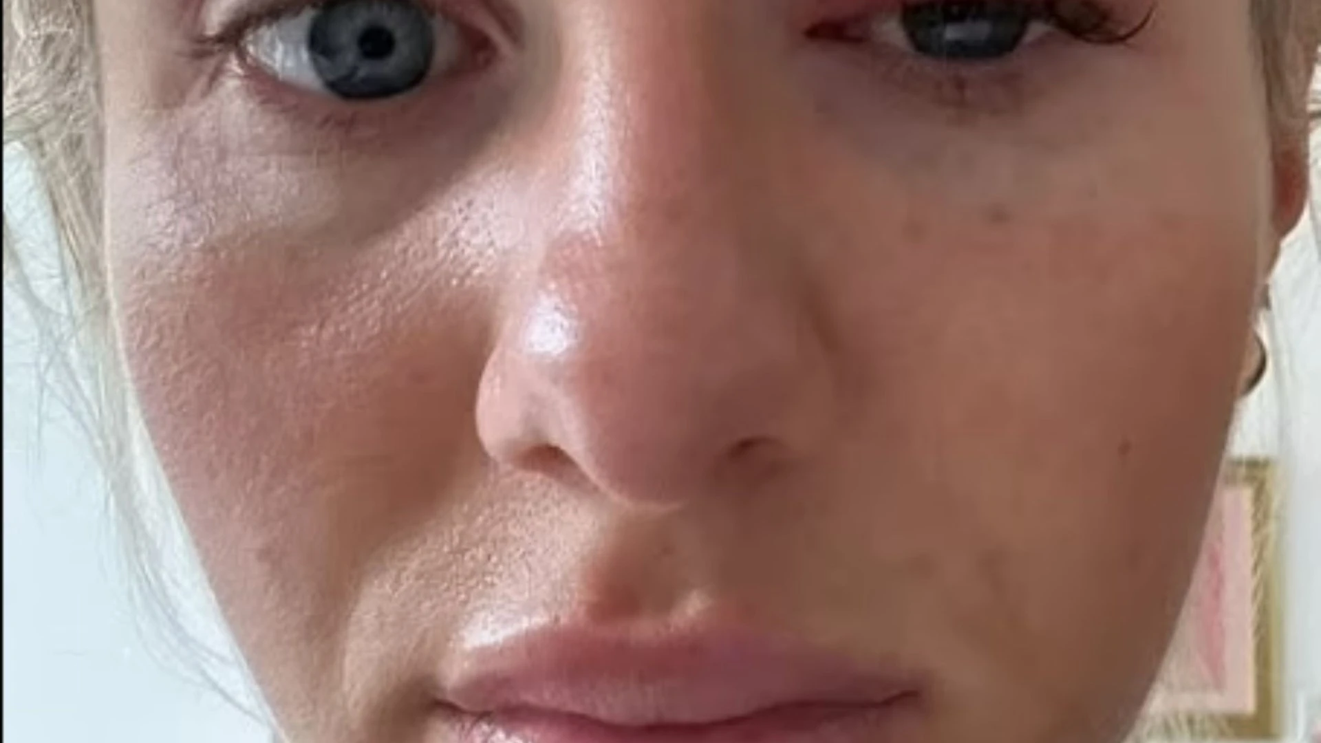 Chloe Burrows sparks concerns as Love Island star sports swollen eye