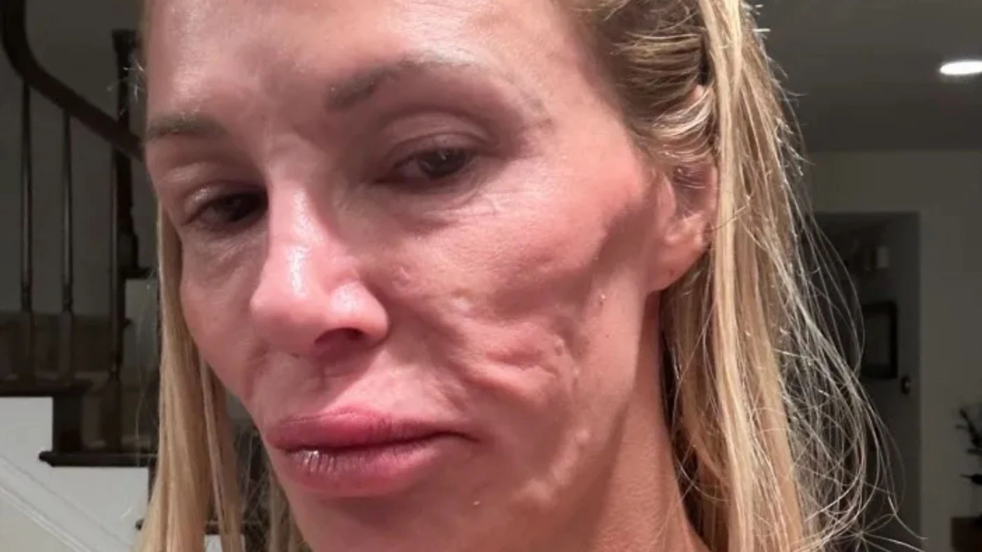 CBB star unrecognisable with swollen face after losing FIVE teeth