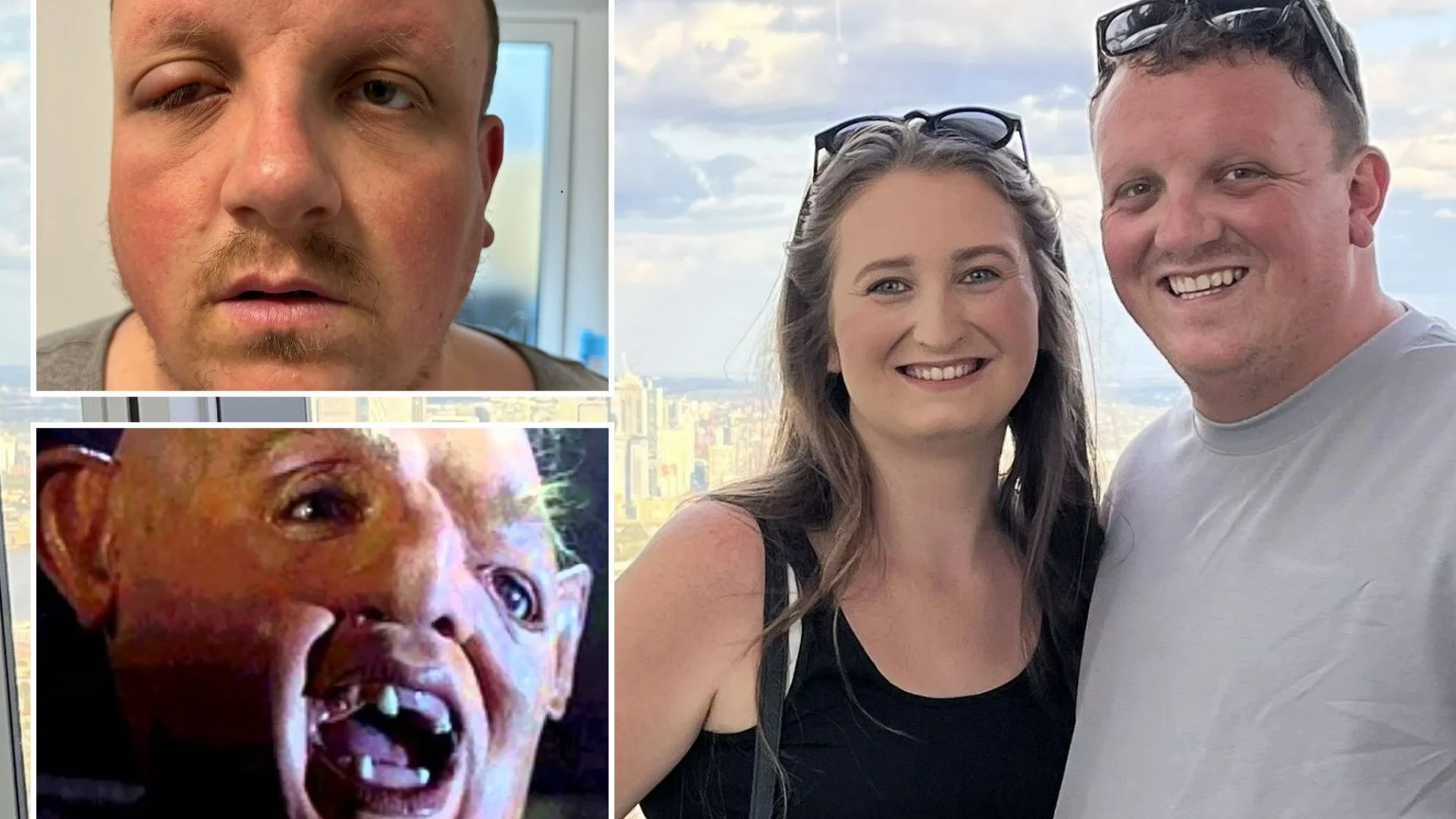 'Pink eye’ was killer bug that left dad looking like ‘Sloth from The Goonies