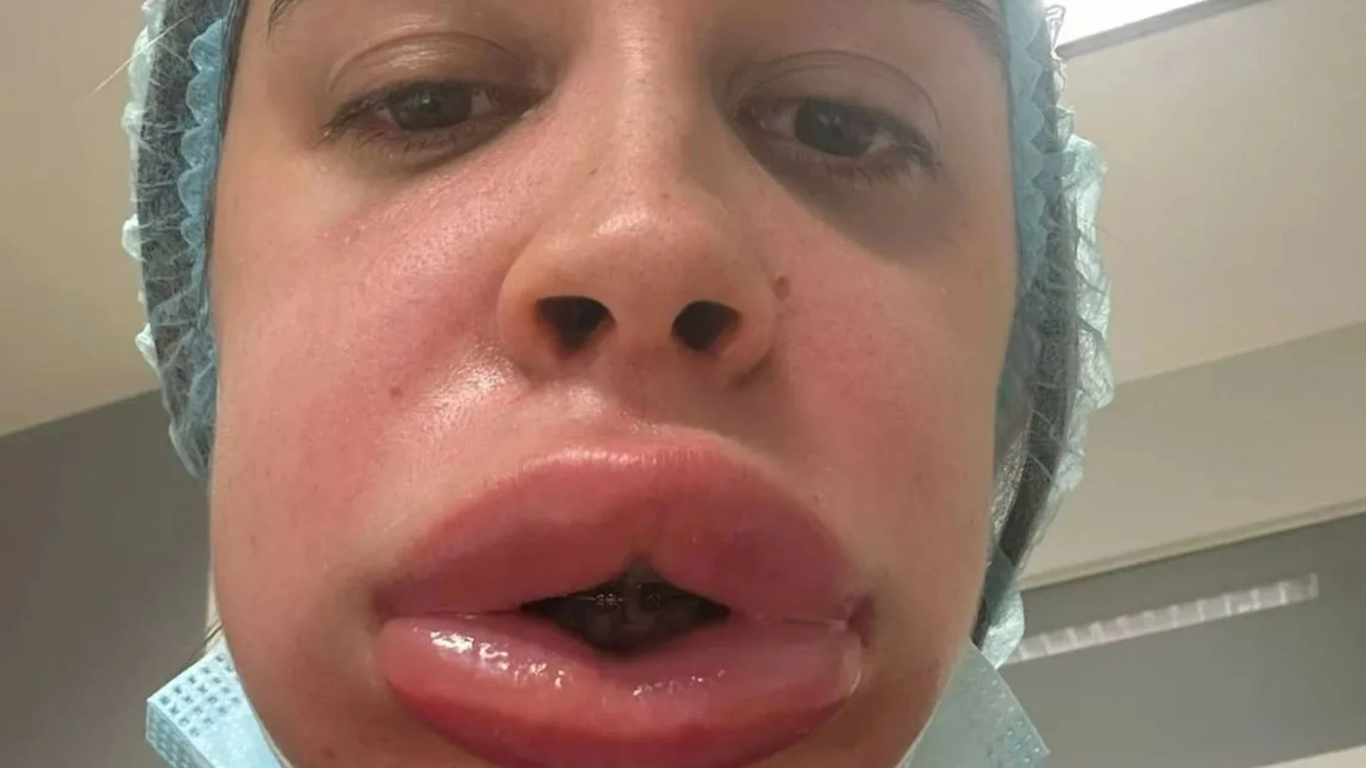 My lips ballooned like a blobfish after having filler REMOVED, I was crying