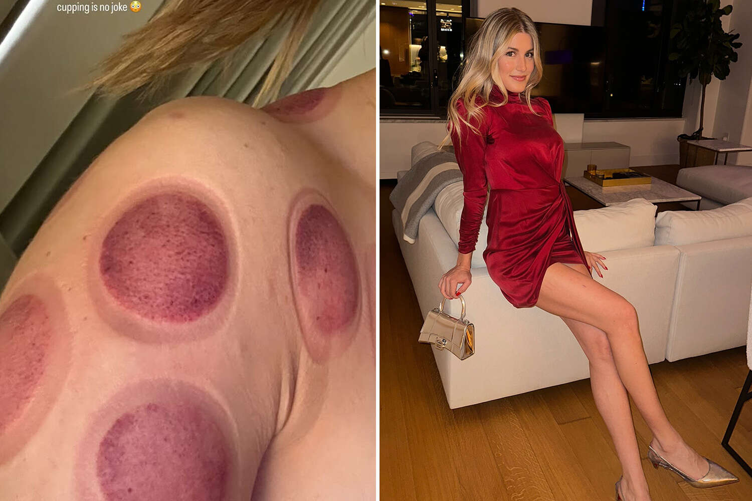 Bouchard shares gory snap of cupping treatment after stunning in red dress