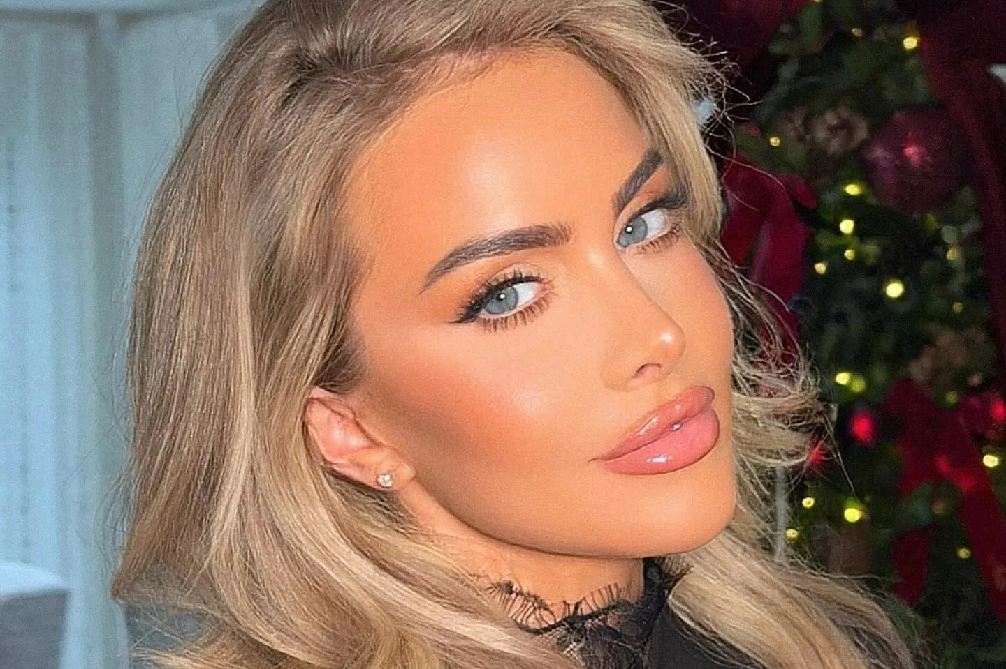 I had a facelift at 34 - surgeons discovered green pus balls left by filler