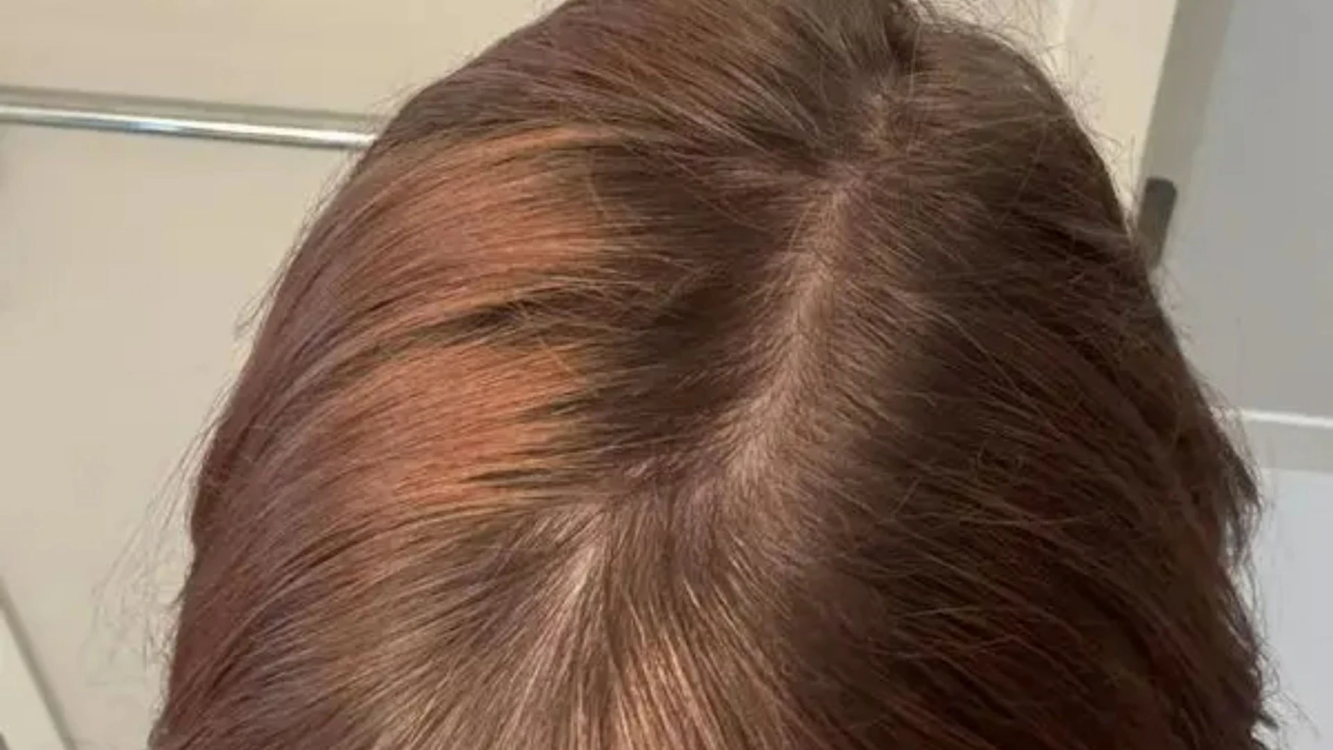 I always had thin hair until using Ordinary’s serum & had new growth in a month