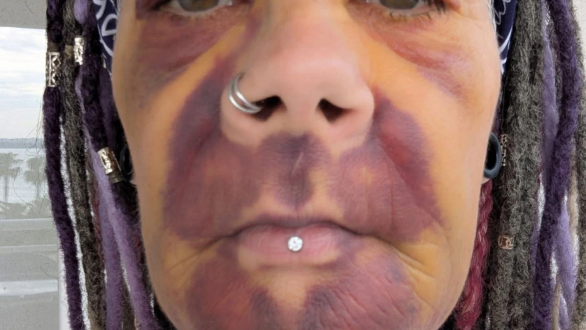 £8k Turkey op left me looking like I'd been in crash… & I'm STILL toothless