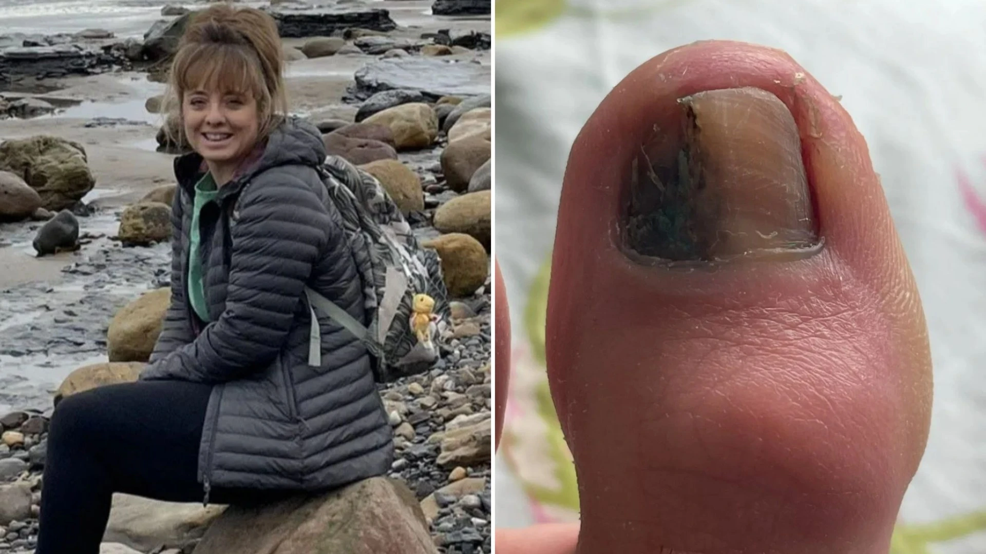 I covered an ugly mark on my toenail with varnish - I had no clue it was cancer