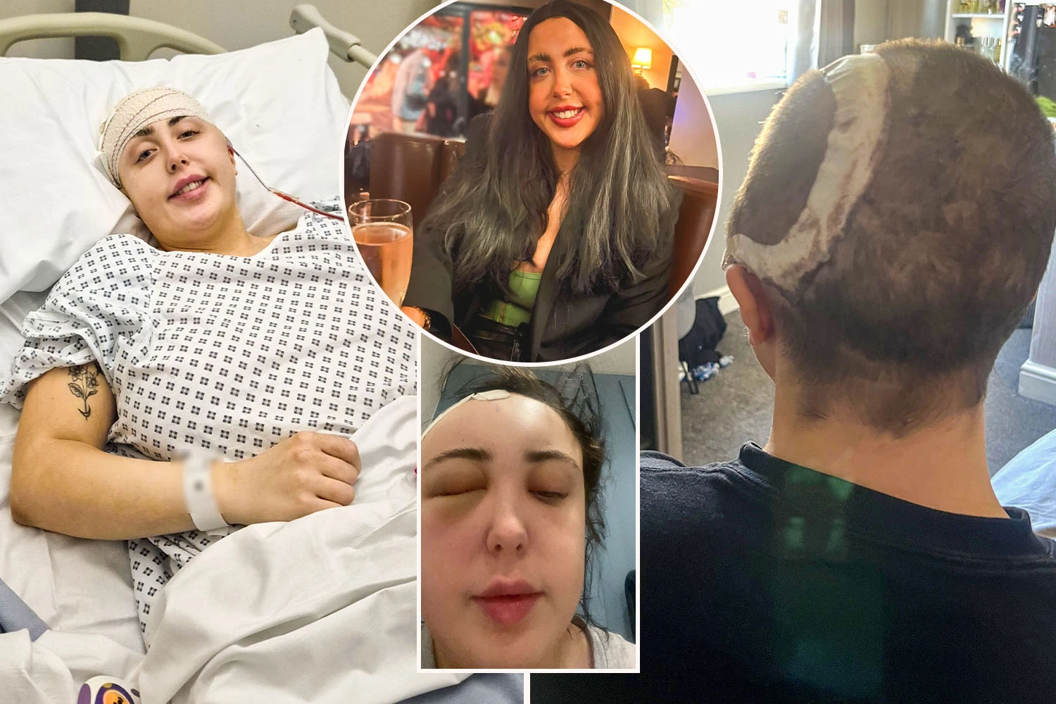 I lost half my skull after drinking rosé with a pal resulted in a horror fall