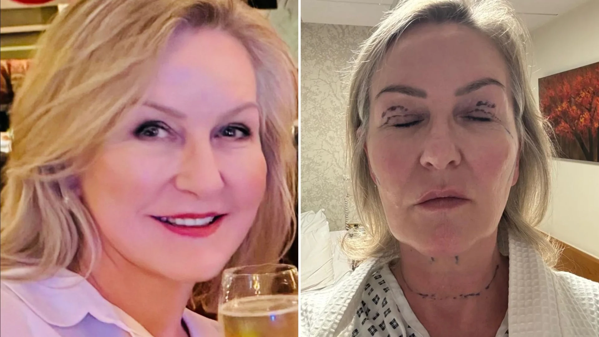 I had a 5-hour op to fix my 'Turkey' neck - I look like I've spent a month in a spa