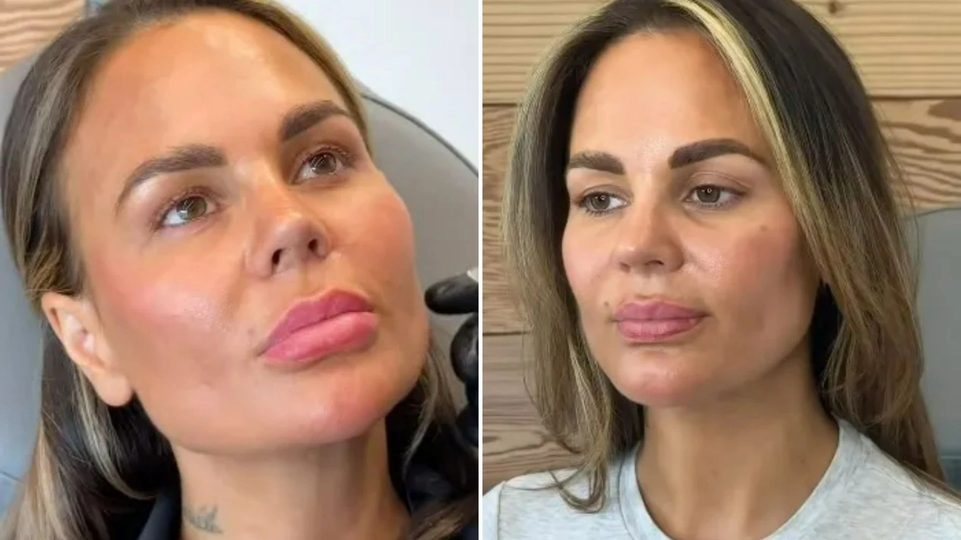 Geordie Shore star looks very different after getting face filler dissolved