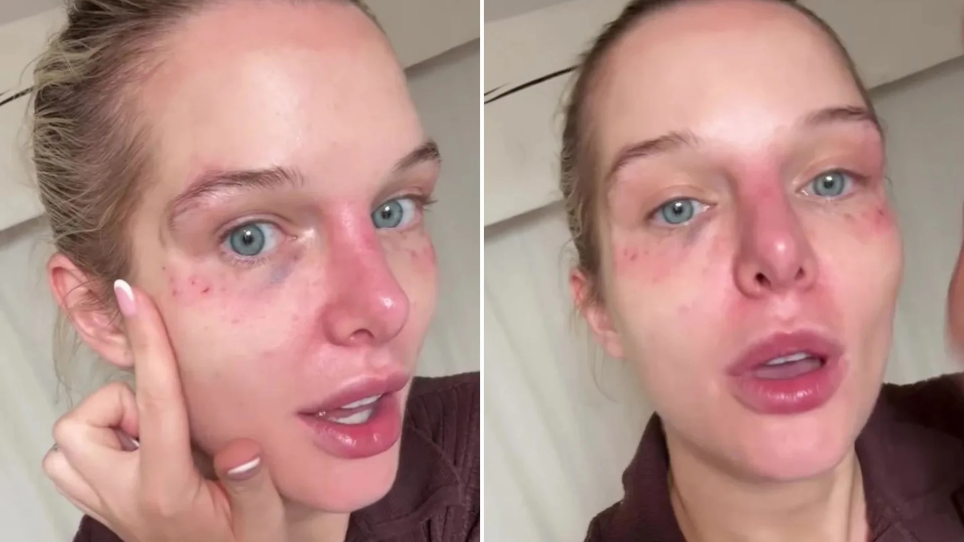 Helen Flanagan shows off her bruised, bloodied face after cosmetic tweakment