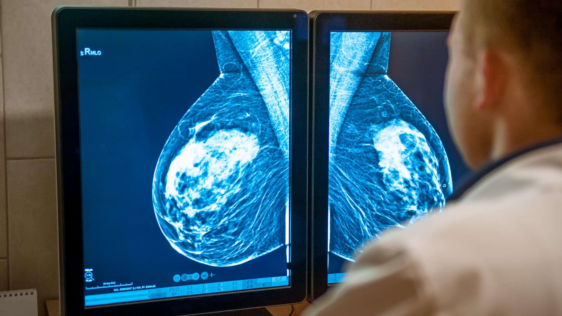 'Landmark' moment as NHS clinics use AI to 'detect breast cancer cases earlier'