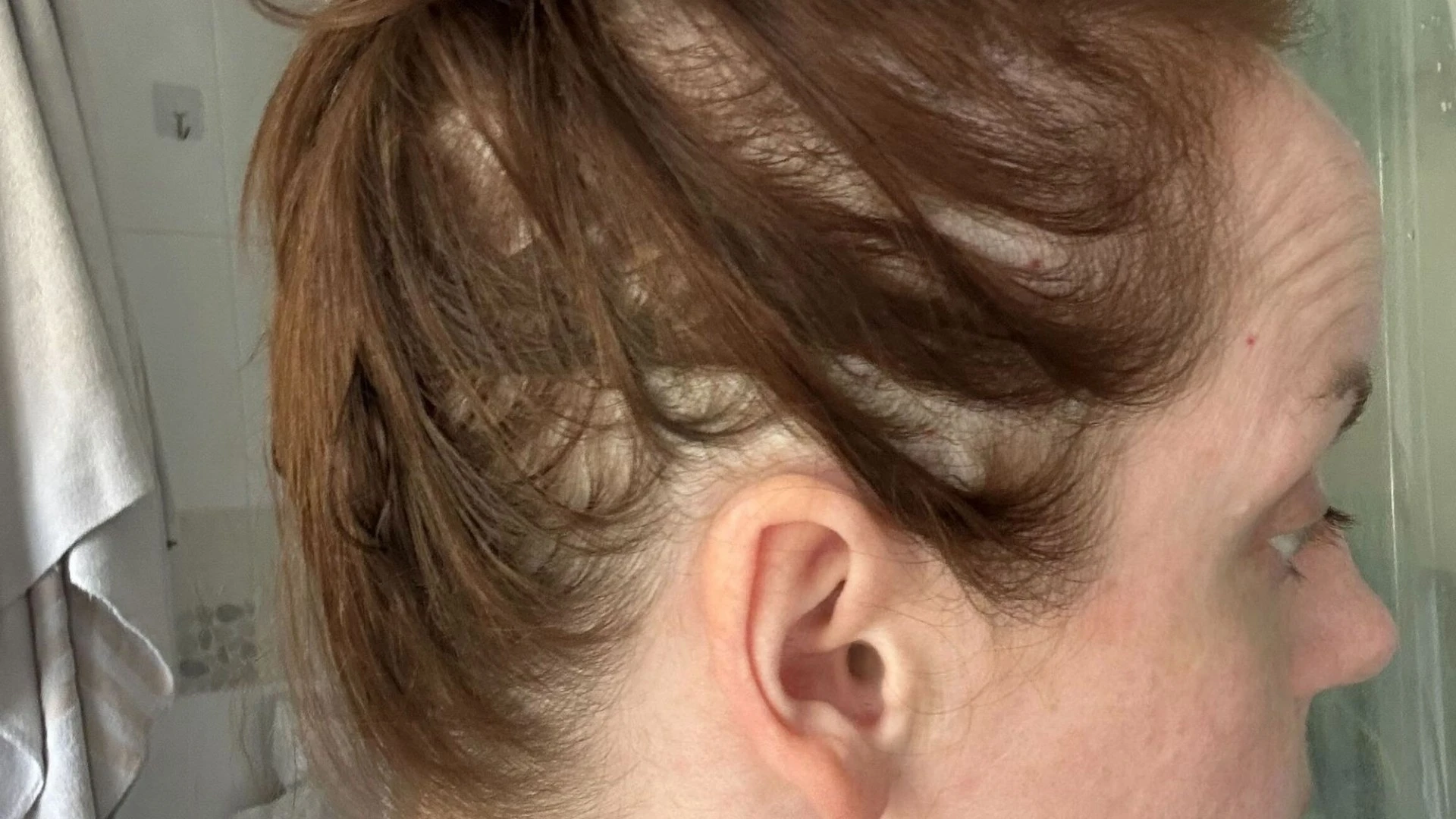 I've had major fat jab hair loss so tried 3 hacks to cover my bald patches