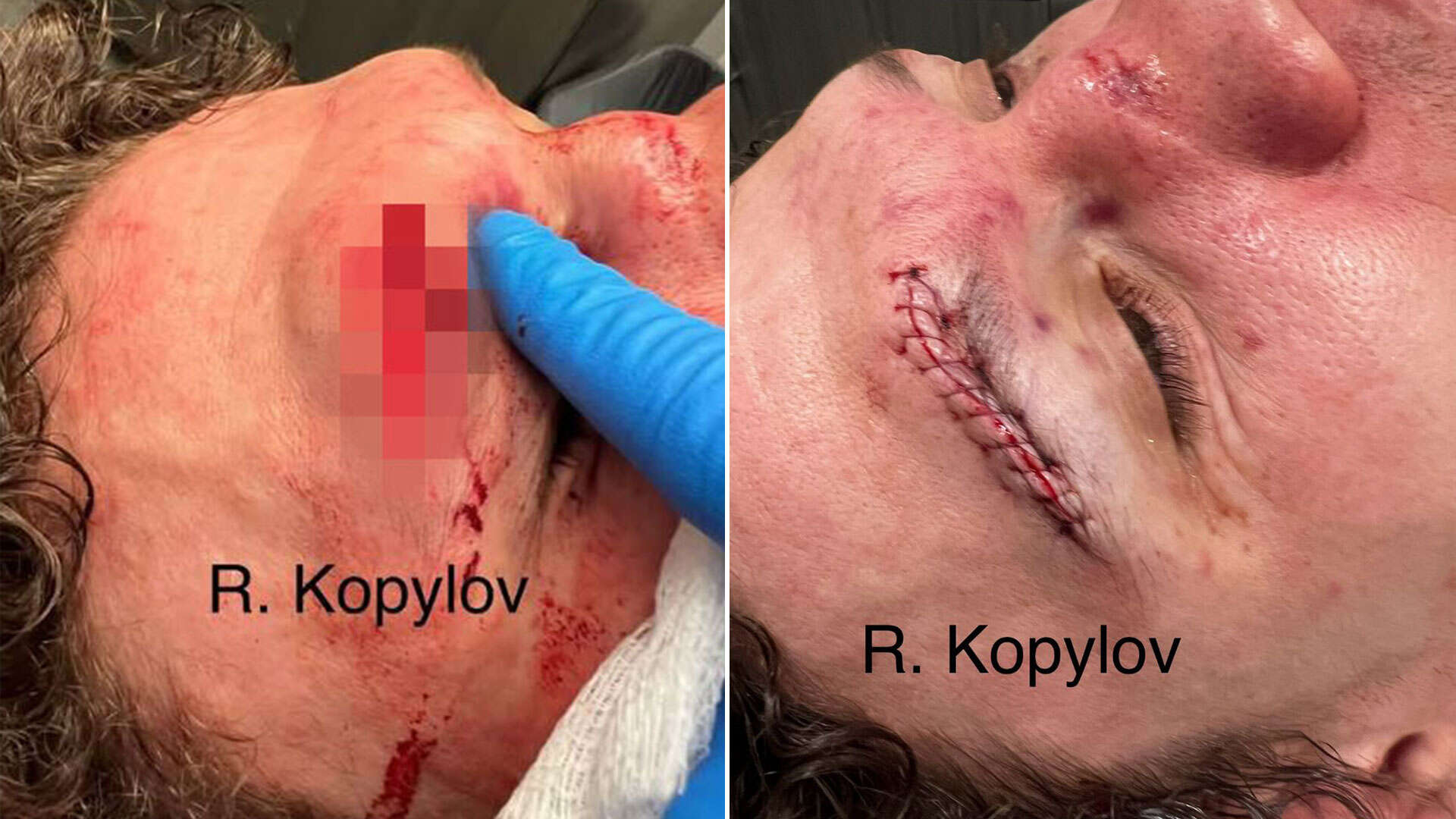 UFC star suffers sickening gash on his head as Dana White shares gruesome snap