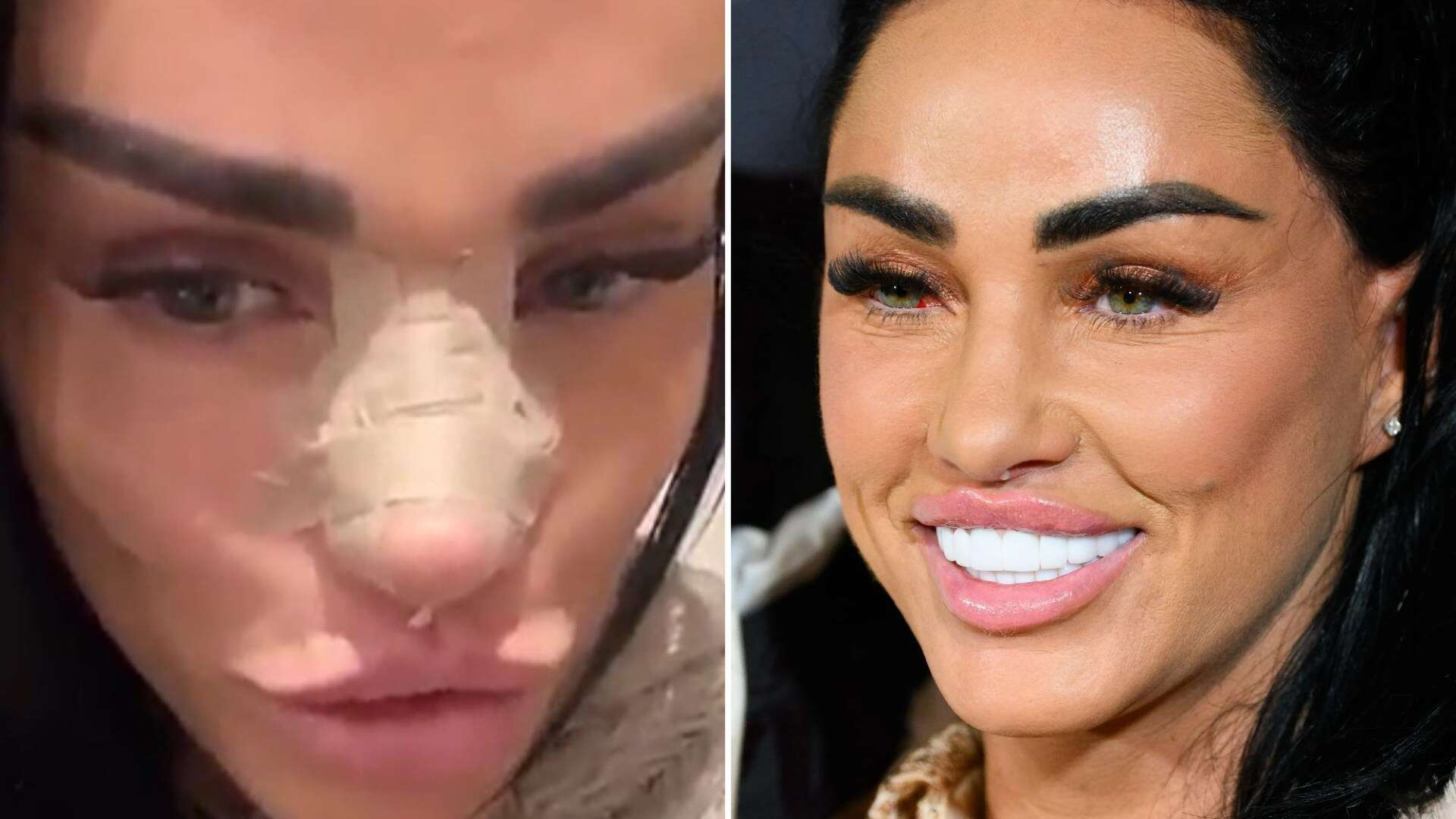 Katie Price shows off 'sore' and bandaged new nose after latest surgery