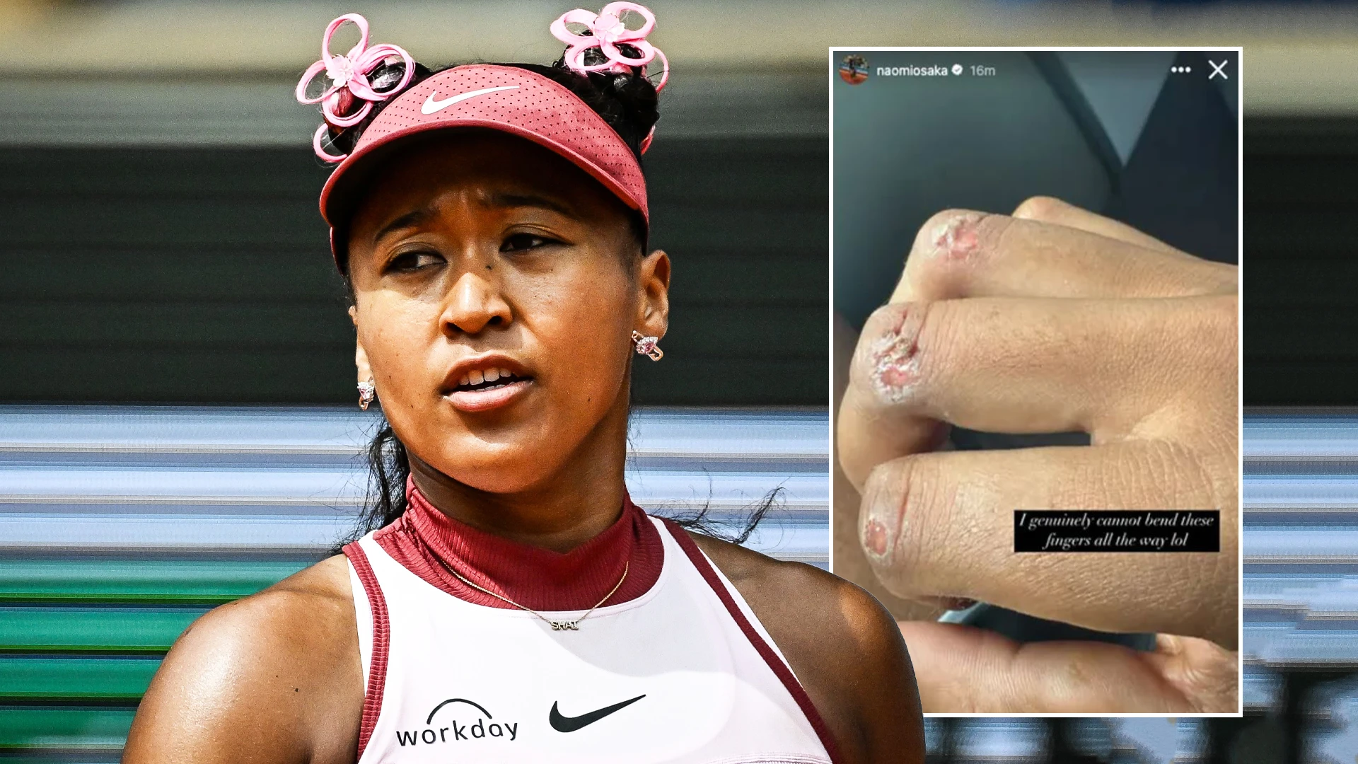 Naomi Osaka mulls tennis break as she reveals nasty hand injury