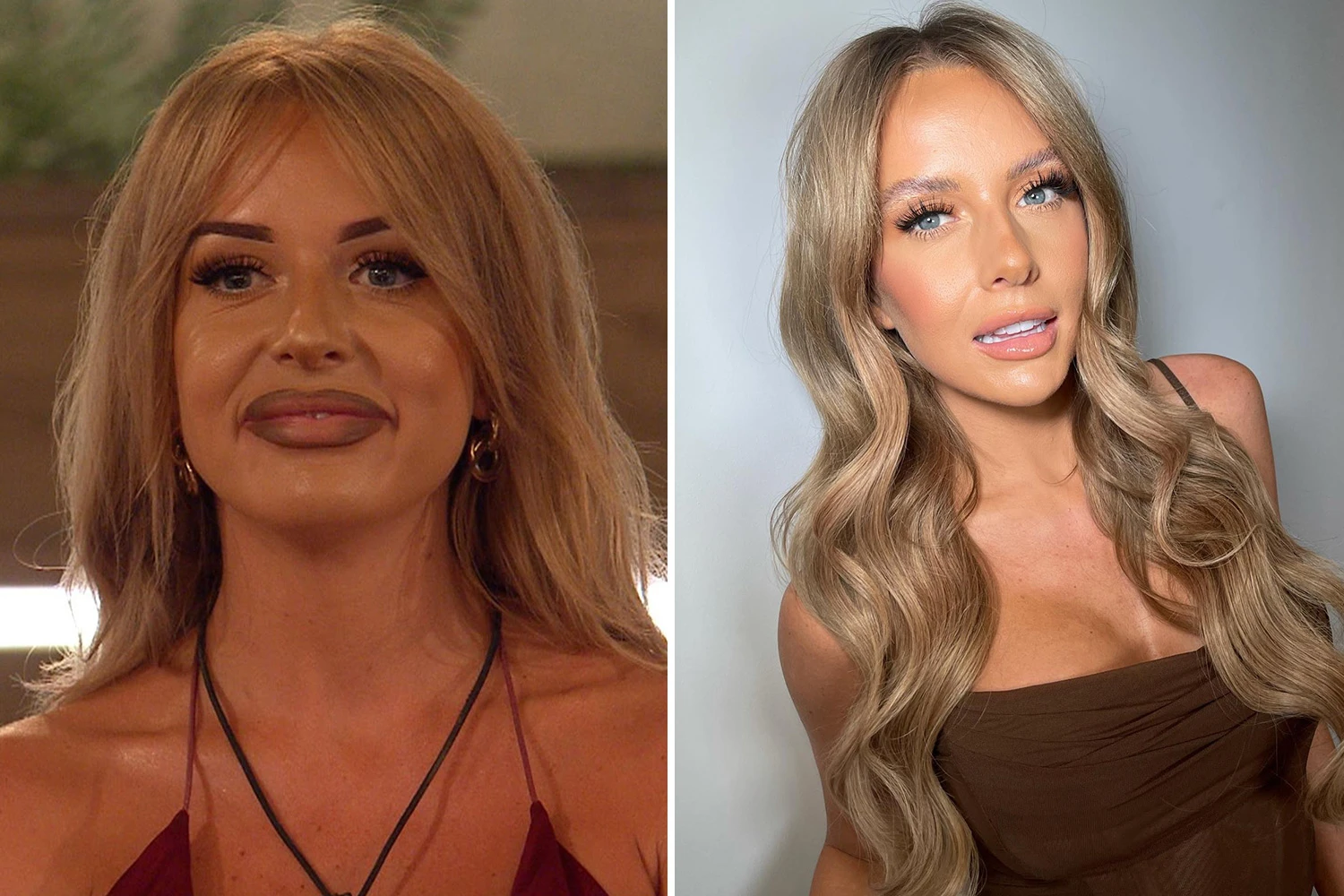 Inside the celeb glow-down trend as they get filler dissolved
