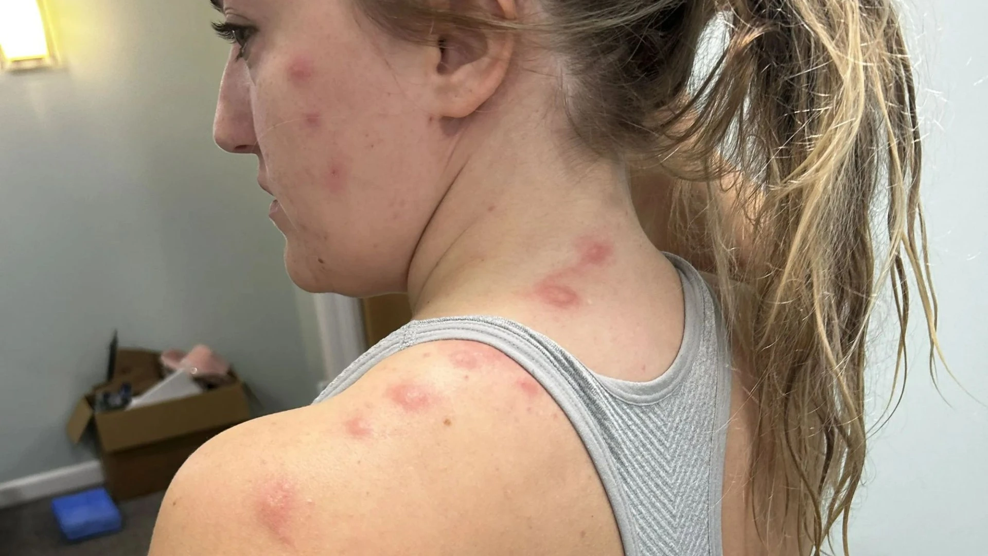I'll never stay in Butlins again after being left covered in pus-filled spots