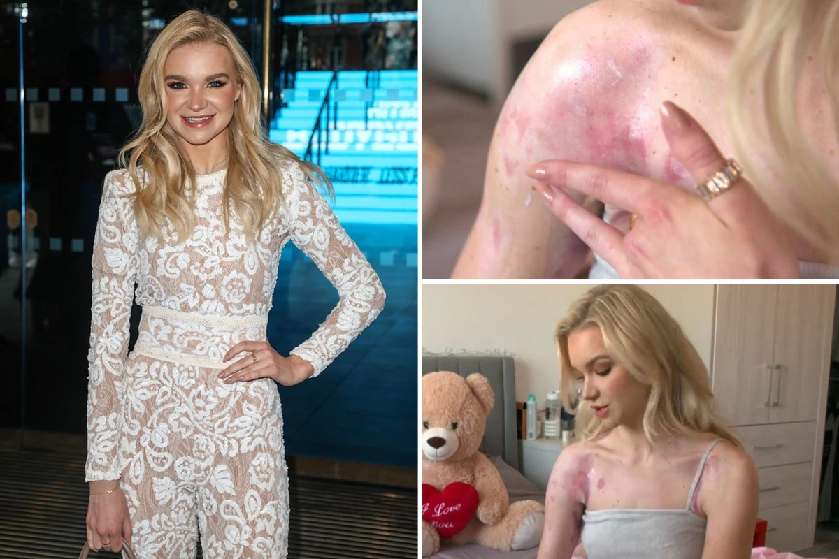 Abbie Quinnen shows true extent of burns 6 months after freak accident with AJ