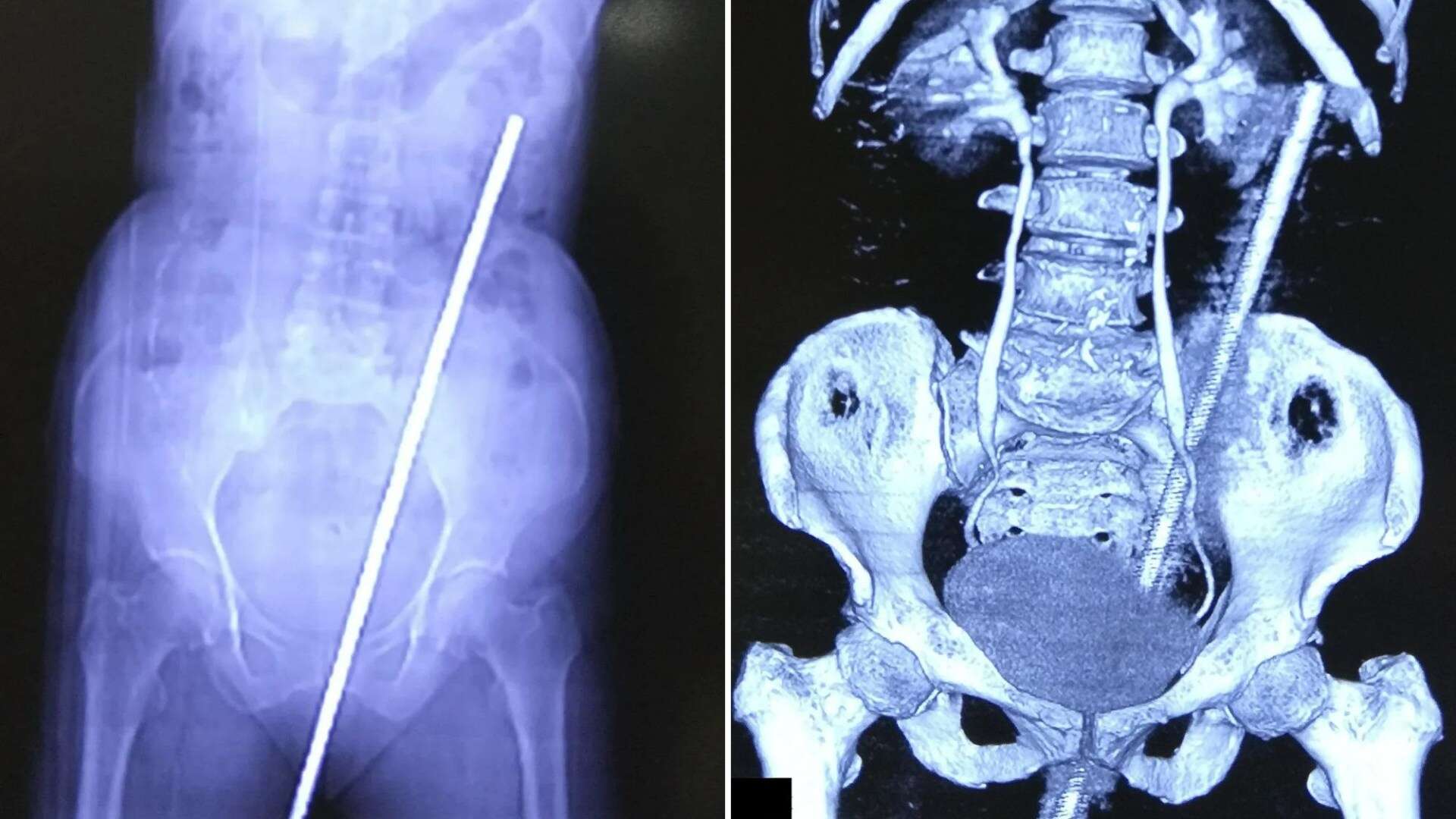 Scans reveal 2ft metal pole removed from woman's backside after garden slip