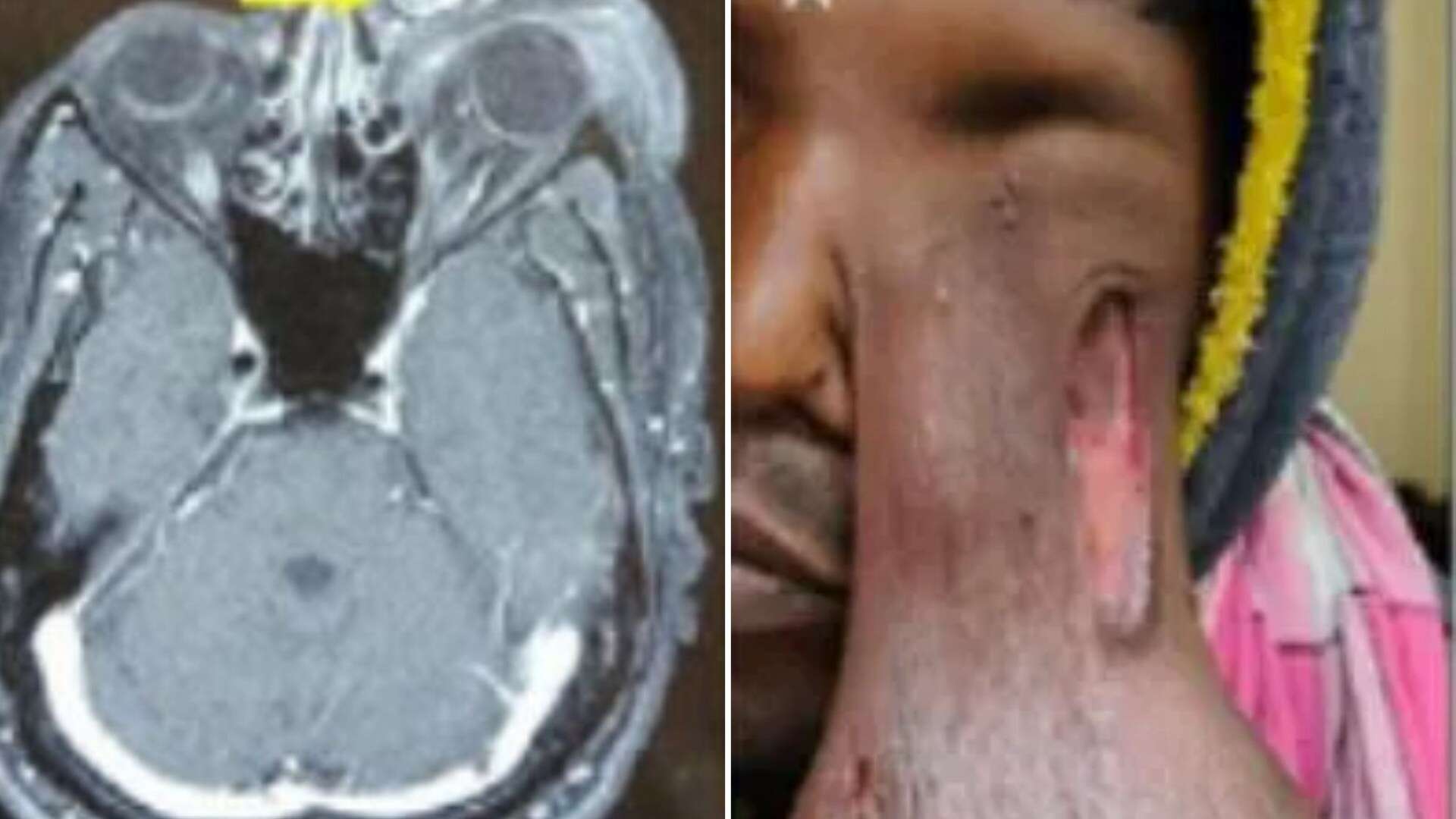 Man blinded by giant tumour hanging to his chest after parasite infected his eye