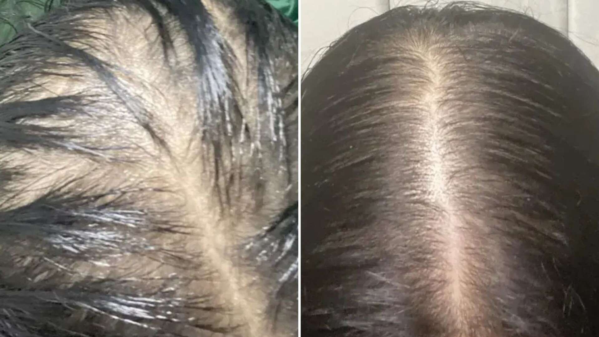 An £11 Superdrug buy stopped my hair from falling out, it grew in just 6 weeks