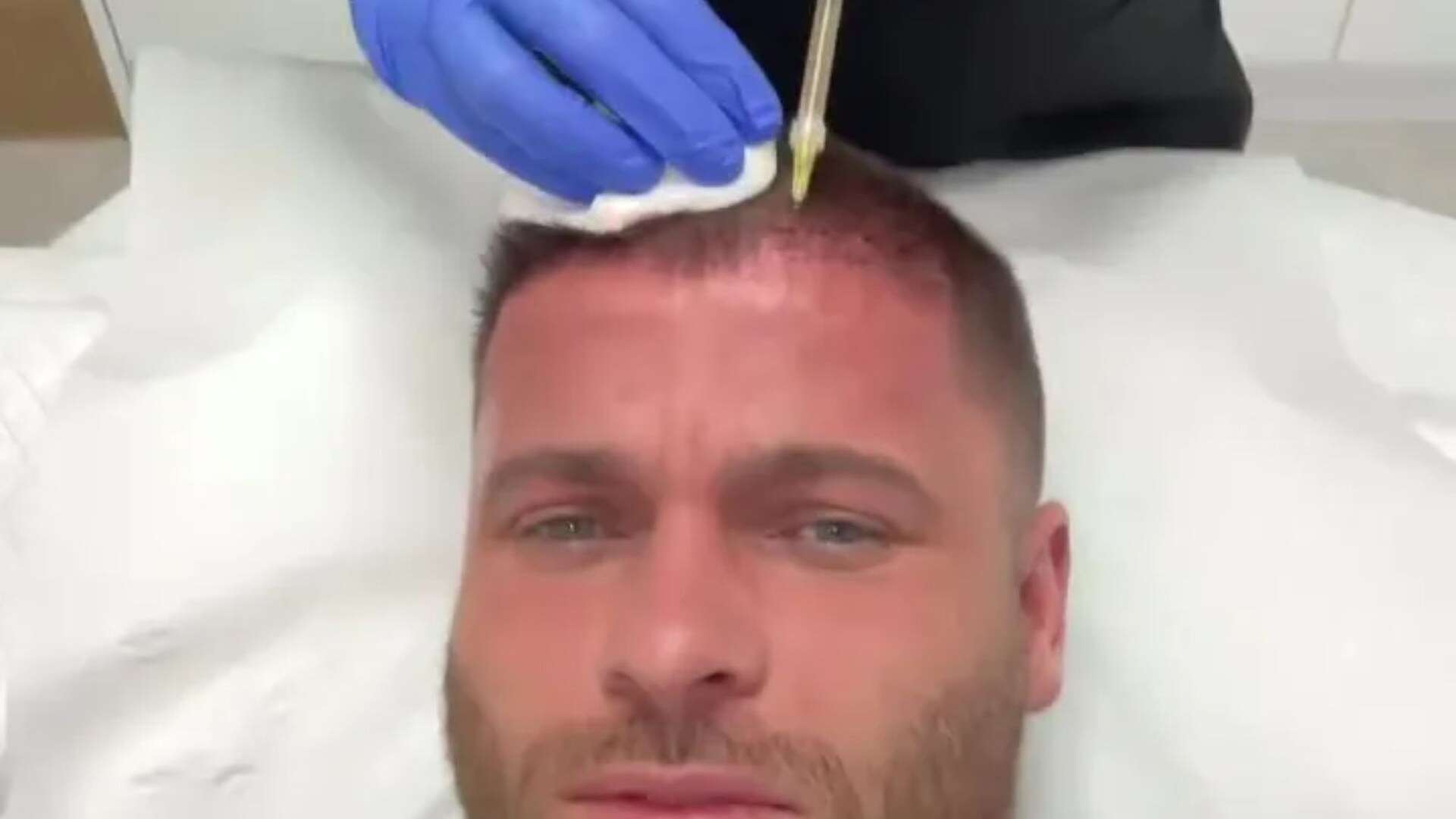 Love Island star gets painful £500 injections in his head in bid to stop hair loss