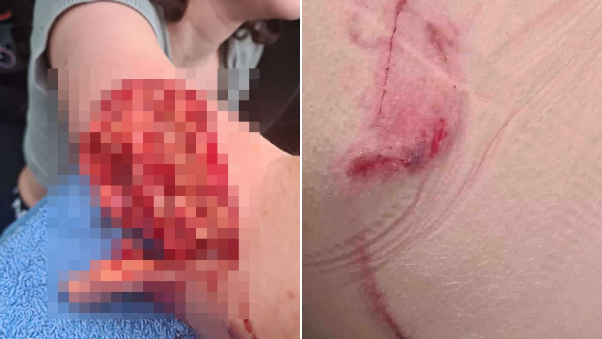 I'm sharing pics of my daughter’s arm after ‘XL Bully’ ripped it apart