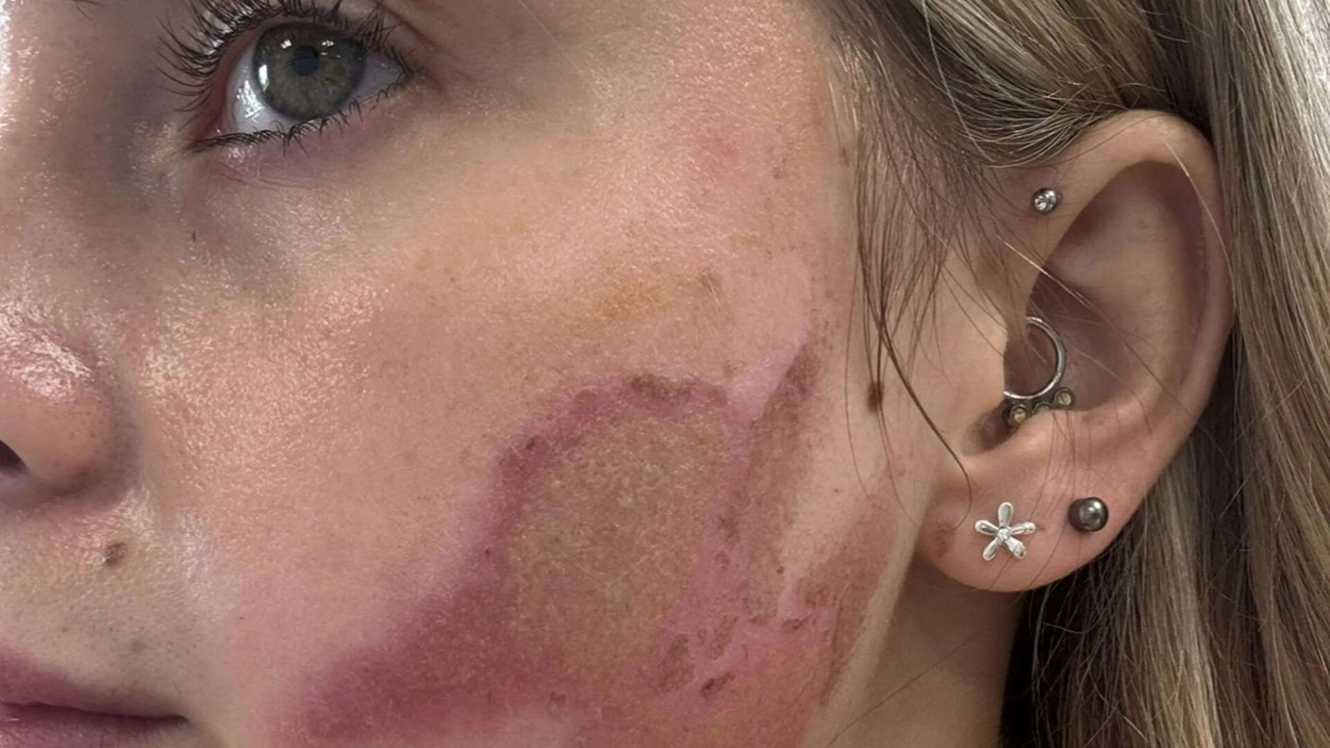 'Botched' acne treatment left burns all over my face - and the clinic blamed ME