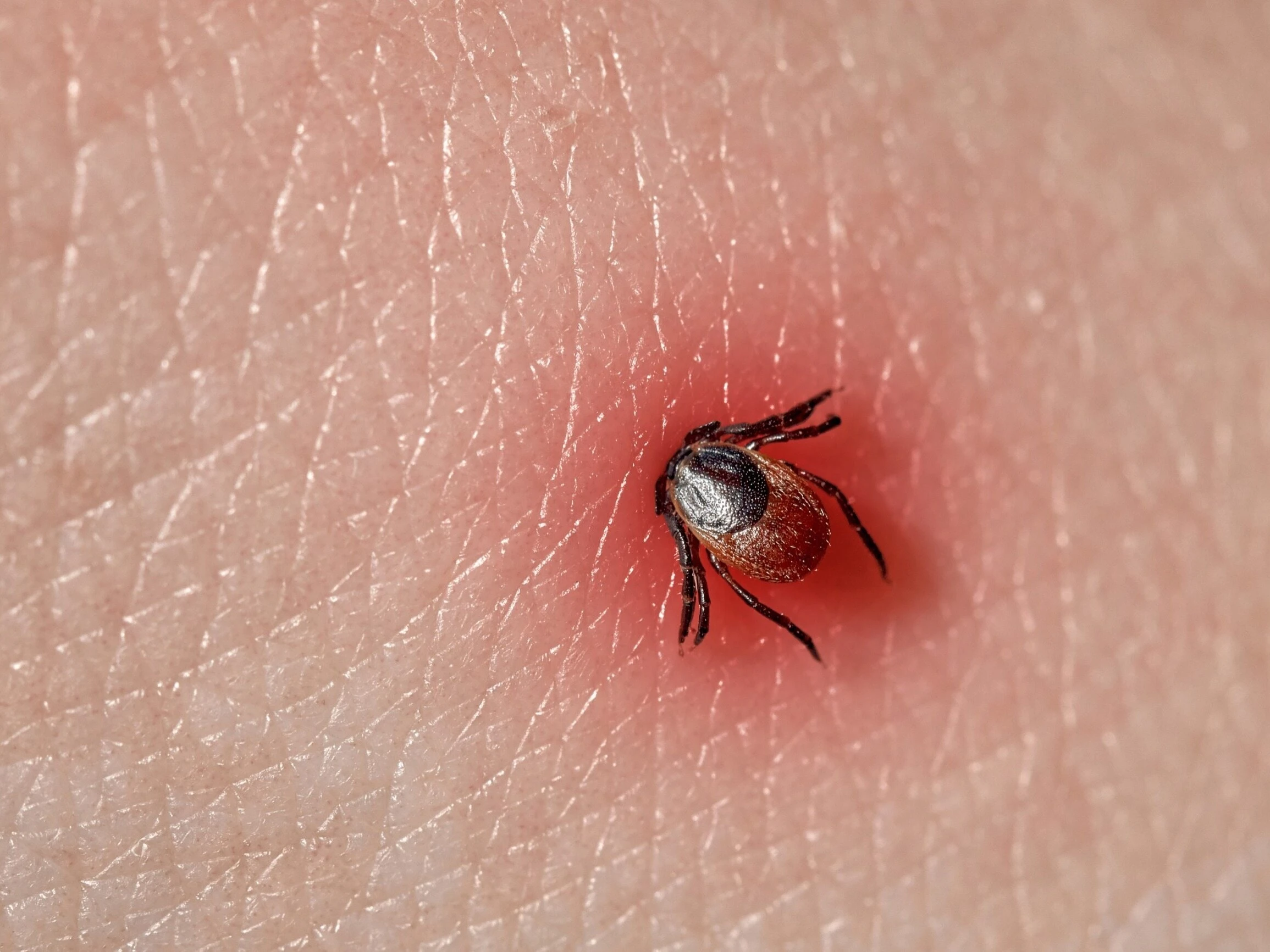 Uwaga na kleszcze! Ich ukąszenie to nie tylko ryzyko boreliozy