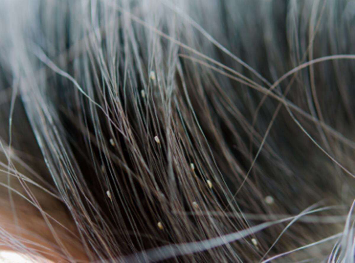 Mulher tem cabelo infestado de piolhos após colocar mega-hair em salão