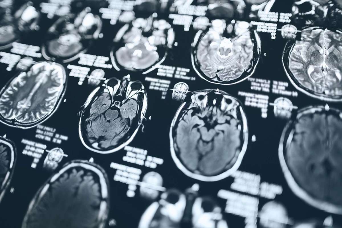 Ressonância cerebral pode prever ritmo de envelhecimento do corpo