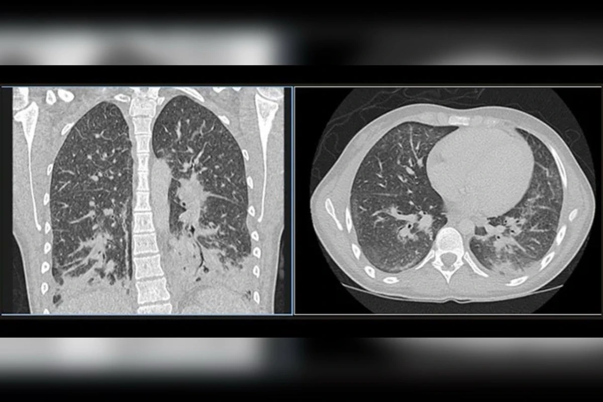 Jovem desenvolve lesão pulmonar grave após uso de cigarro eletrônico