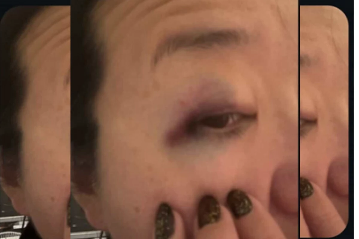 Vídeo. Corredora fica com olho roxo após agressão no Ibirapuera