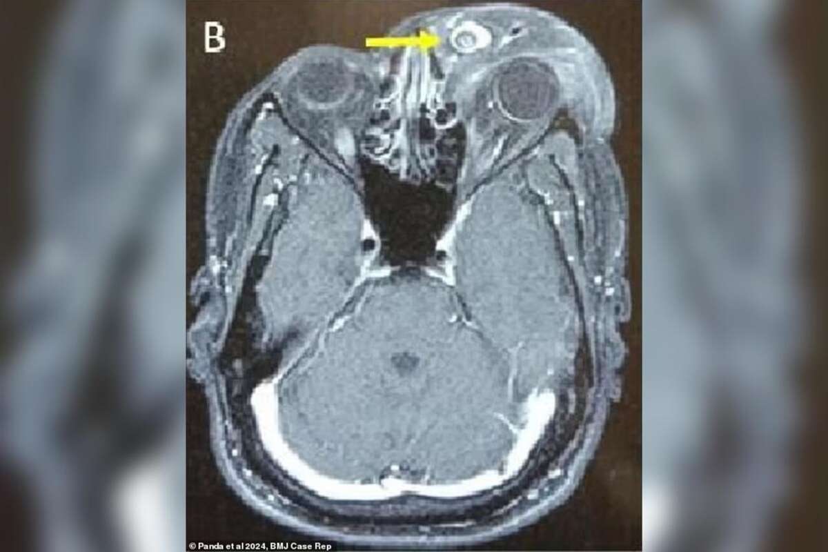 Homem desenvolve tumor gigante após parasita se alojar no olho