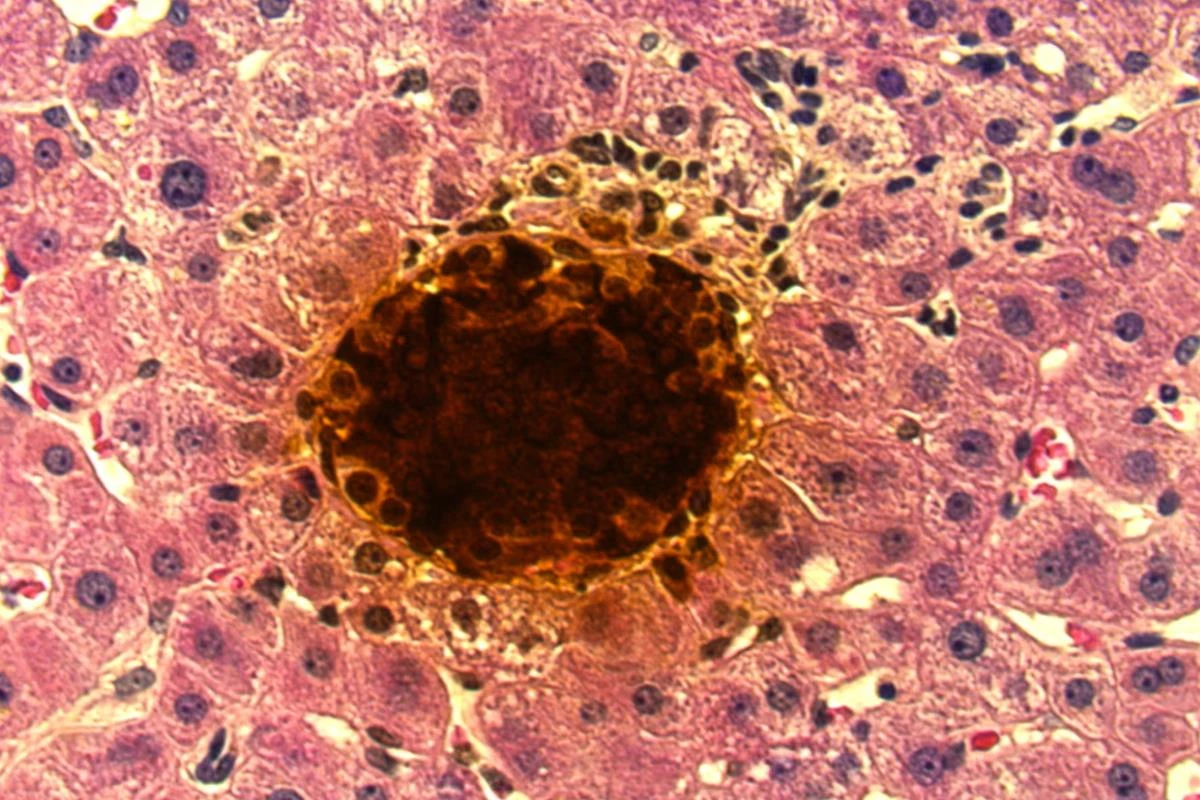 1º transplante com terapia inovadora para diabetes é realizado nos EUA