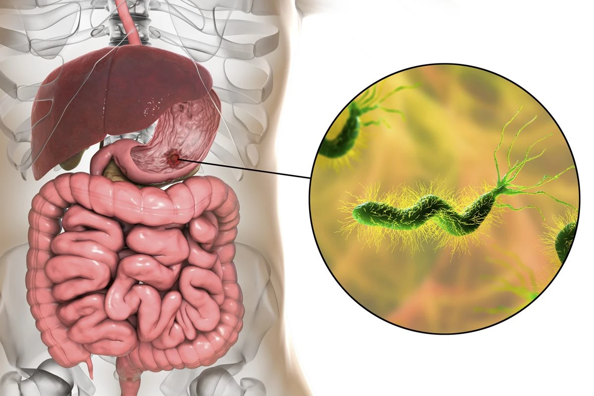 Médico aponta chá anti-inflamatório que ajuda a combater a H. pylori